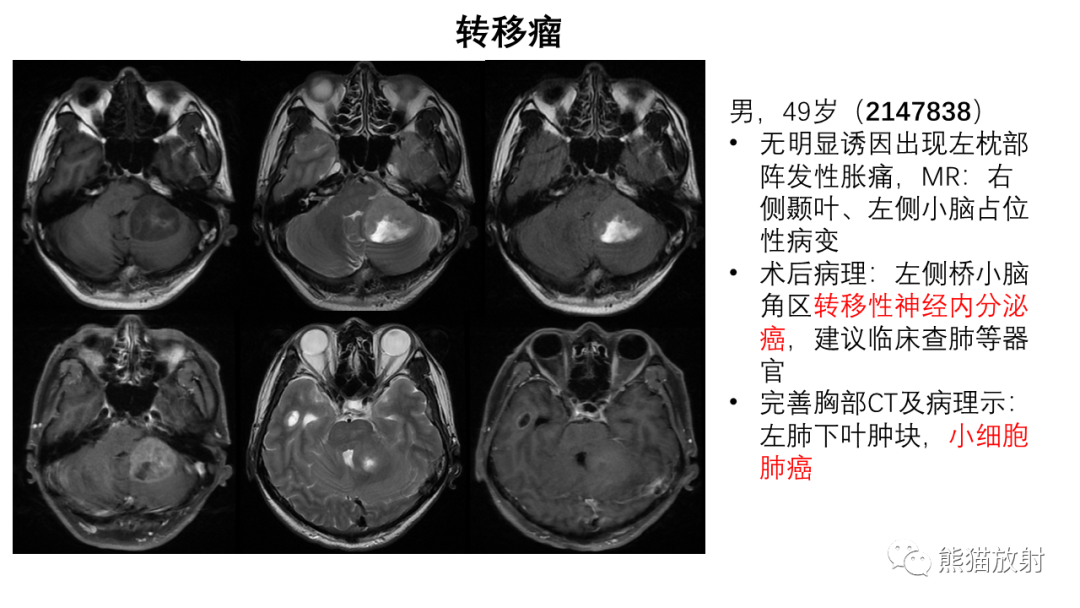 影像PPT - 【病例】桥小脑角区占位—副神经节瘤 VS 室管膜瘤-29