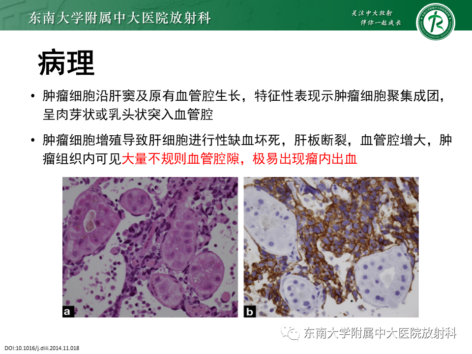 影像PPT - 【PPT】肝血管肉瘤-8