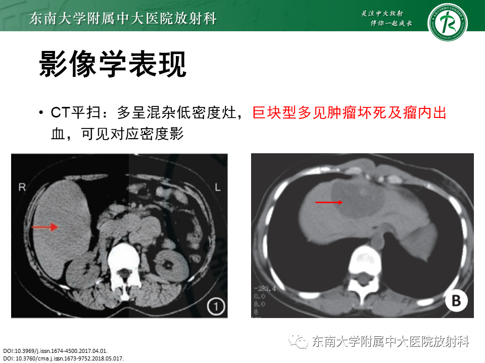 影像PPT - 【PPT】肝血管肉瘤-10