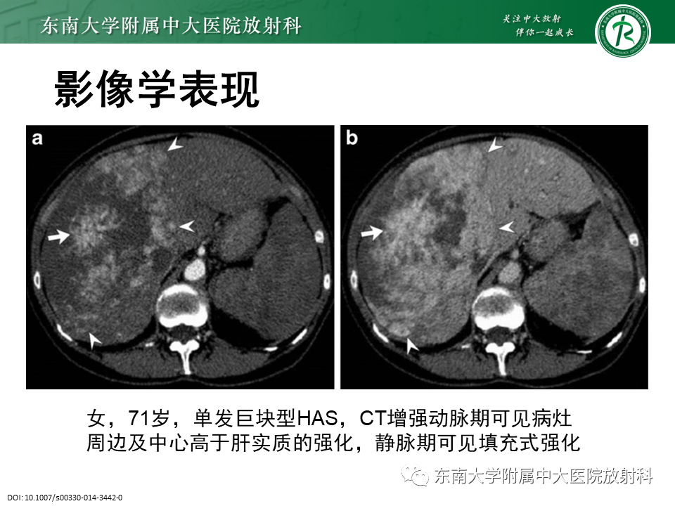 影像PPT - 【PPT】肝血管肉瘤-12