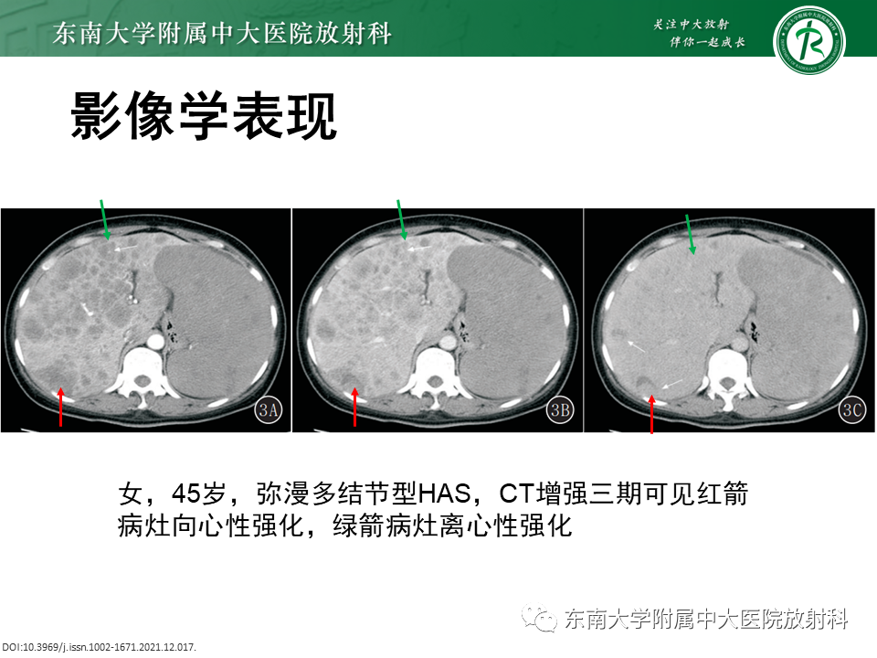 影像PPT - 【PPT】肝血管肉瘤-14