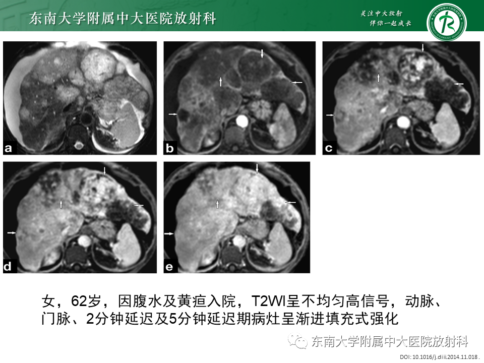 影像PPT - 【PPT】肝血管肉瘤-17