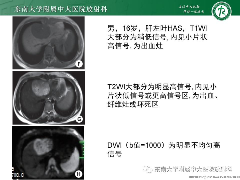 影像PPT - 【PPT】肝血管肉瘤-16
