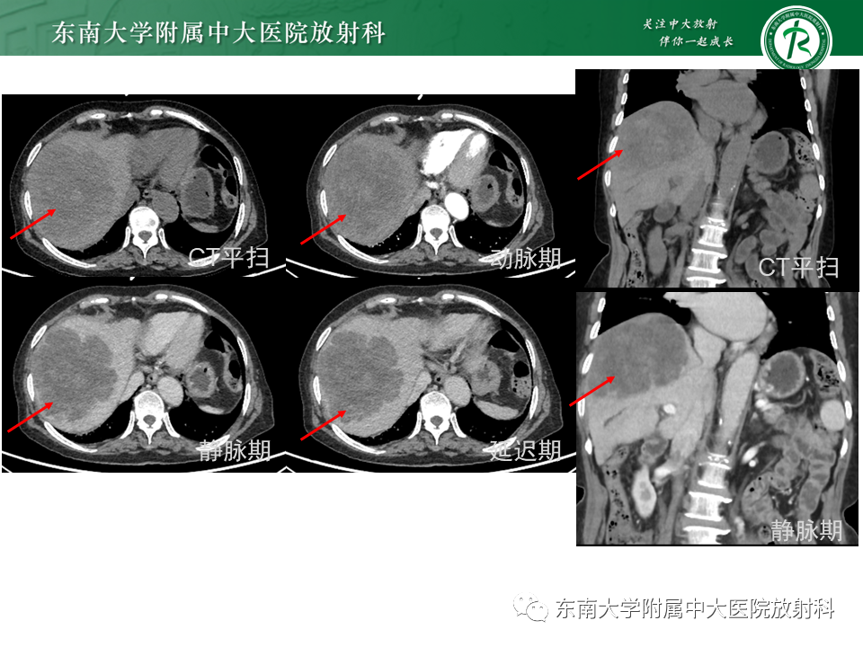 影像PPT - 【PPT】肝血管肉瘤-19