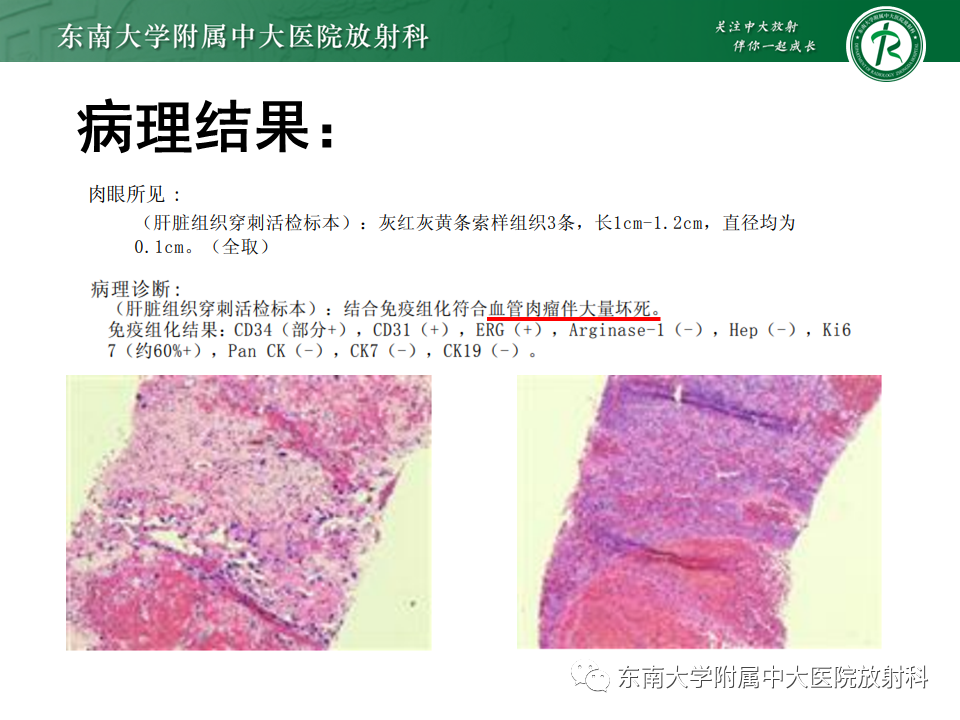 影像PPT - 【PPT】肝血管肉瘤-20