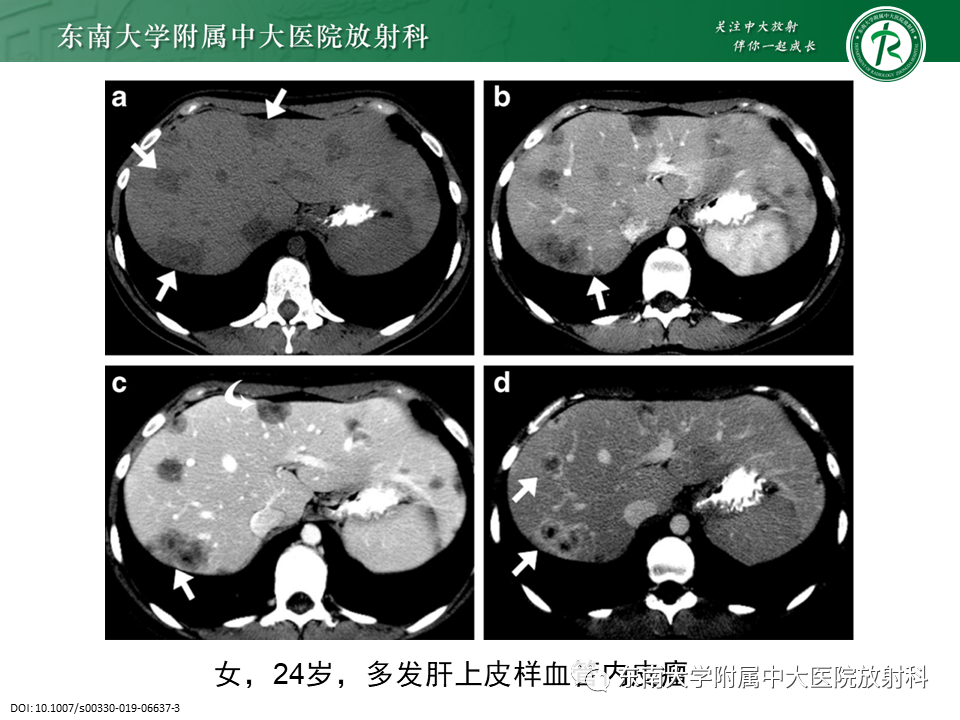 影像PPT - 【PPT】肝血管肉瘤-25