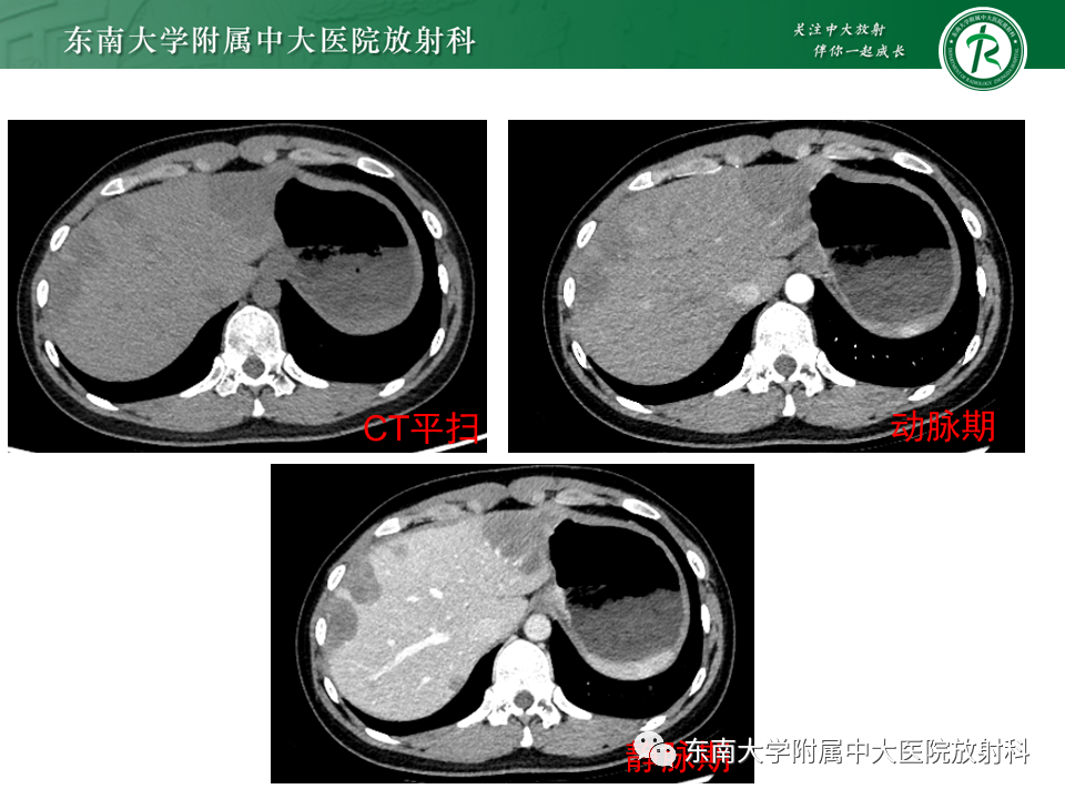 影像PPT - 【PPT】肝血管肉瘤-27
