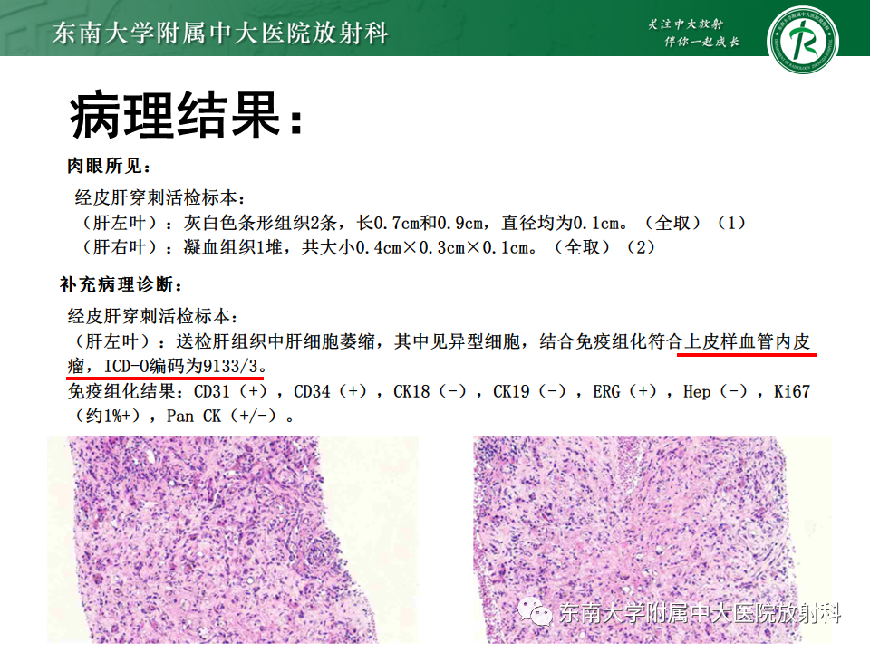 影像PPT - 【PPT】肝血管肉瘤-28