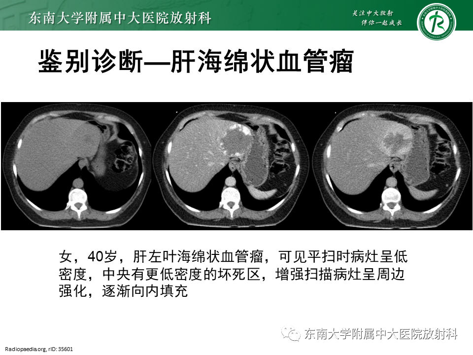 影像PPT - 【PPT】肝血管肉瘤-30