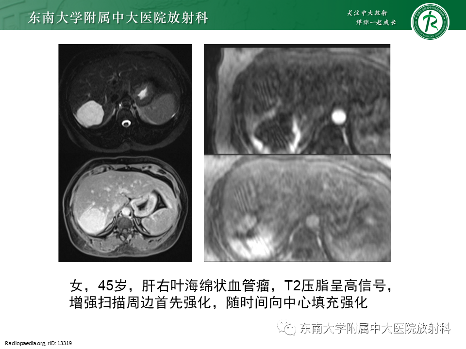 影像PPT - 【PPT】肝血管肉瘤-31