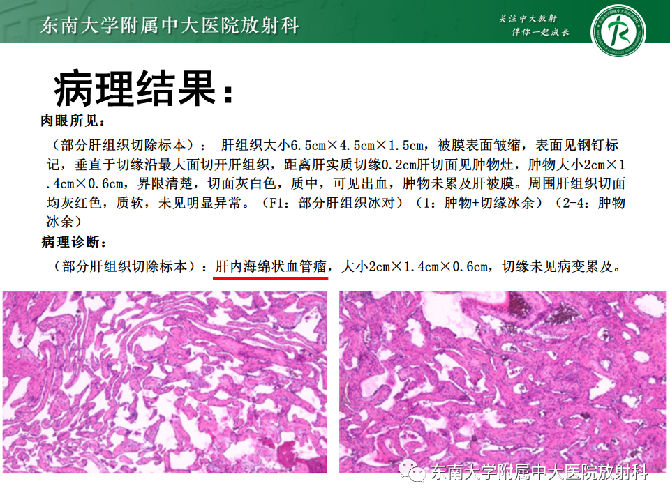 影像PPT - 【PPT】肝血管肉瘤-34