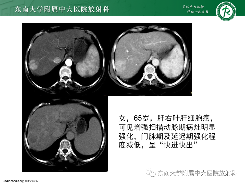 影像PPT - 【PPT】肝血管肉瘤-37