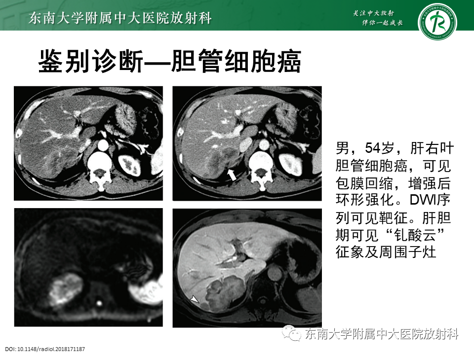 影像PPT - 【PPT】肝血管肉瘤-39