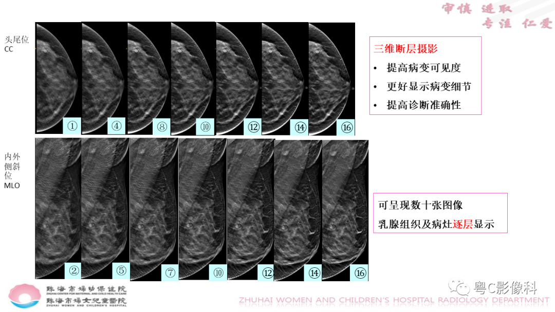 影像PPT - 【PPT】DBT在乳腺癌筛查与诊断中的应用体会-17