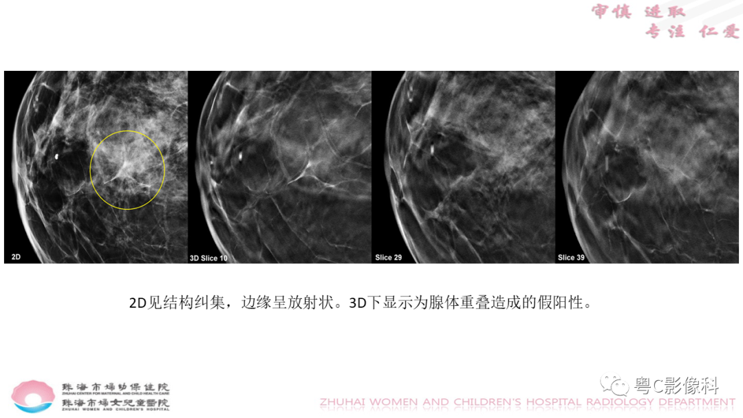 影像PPT - 【PPT】DBT在乳腺癌筛查与诊断中的应用体会-20