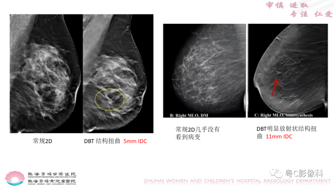 影像PPT - 【PPT】DBT在乳腺癌筛查与诊断中的应用体会-21