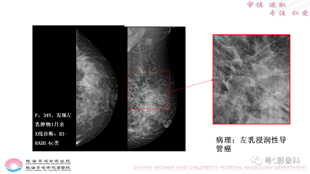 影像PPT - 【PPT】DBT在乳腺癌筛查与诊断中的应用体会-25