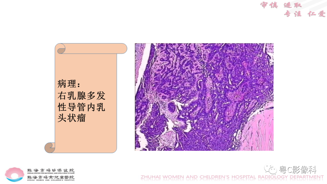 影像PPT - 【PPT】DBT在乳腺癌筛查与诊断中的应用体会-42