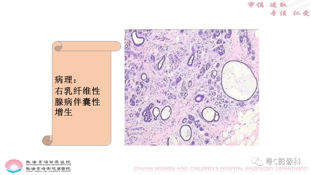 影像PPT - 【PPT】DBT在乳腺癌筛查与诊断中的应用体会-47