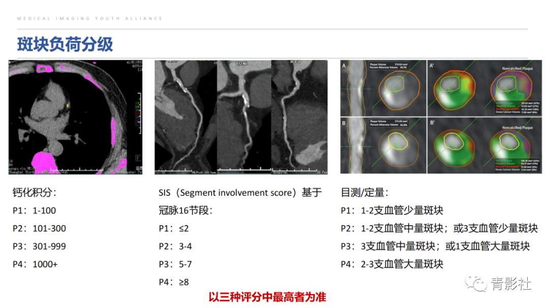 影像PPT - 【PPT】CAD-RADS 2.0报告分级解读-26