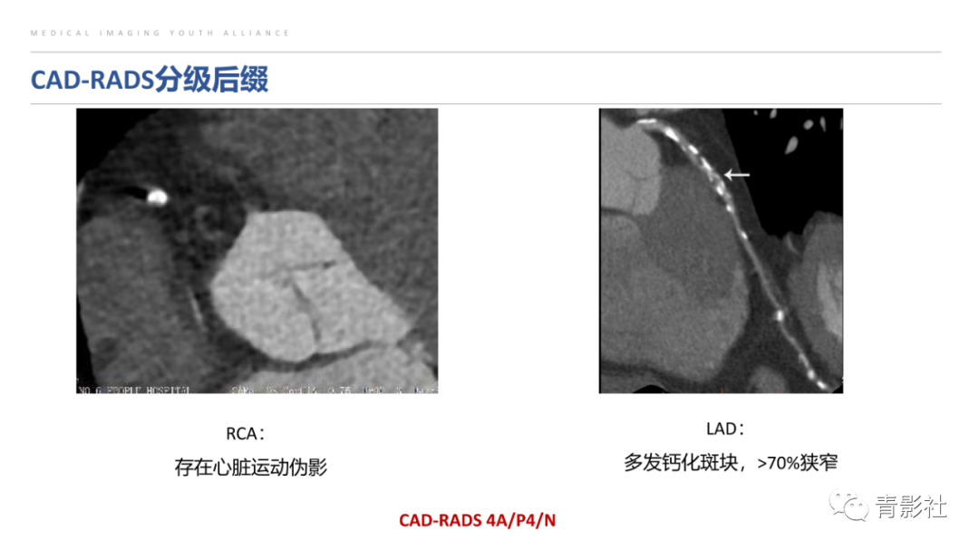 影像PPT - 【PPT】CAD-RADS 2.0报告分级解读-30