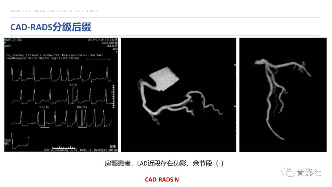 影像PPT - 【PPT】CAD-RADS 2.0报告分级解读-31