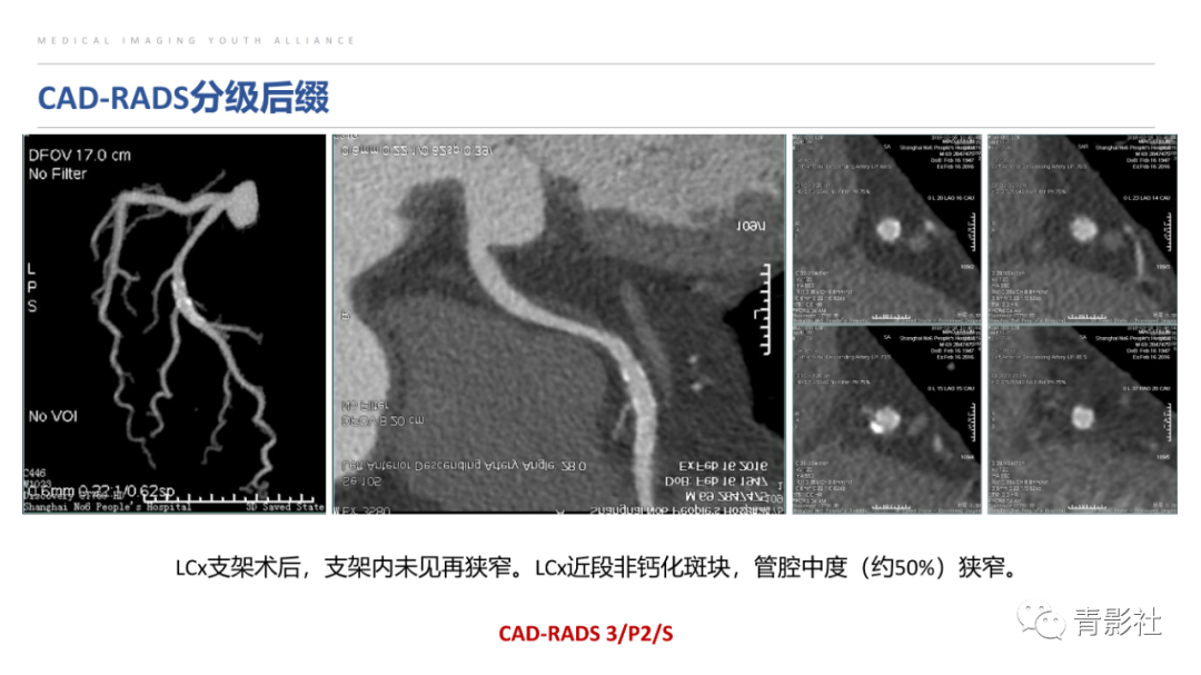 影像PPT - 【PPT】CAD-RADS 2.0报告分级解读-33