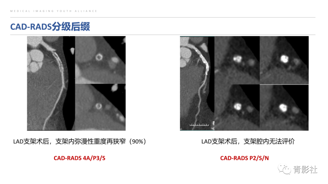 影像PPT - 【PPT】CAD-RADS 2.0报告分级解读-34