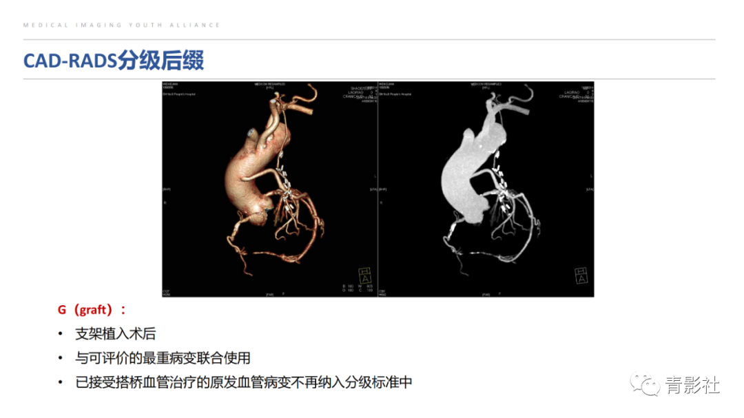 影像PPT - 【PPT】CAD-RADS 2.0报告分级解读-35