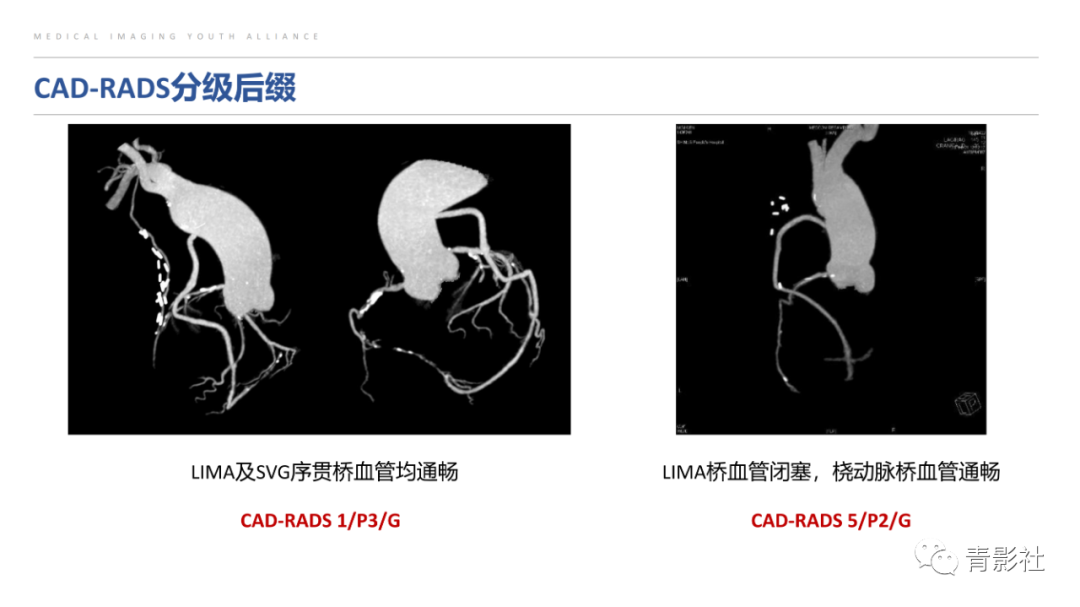 影像PPT - 【PPT】CAD-RADS 2.0报告分级解读-36