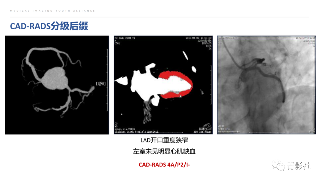 影像PPT - 【PPT】CAD-RADS 2.0报告分级解读-42