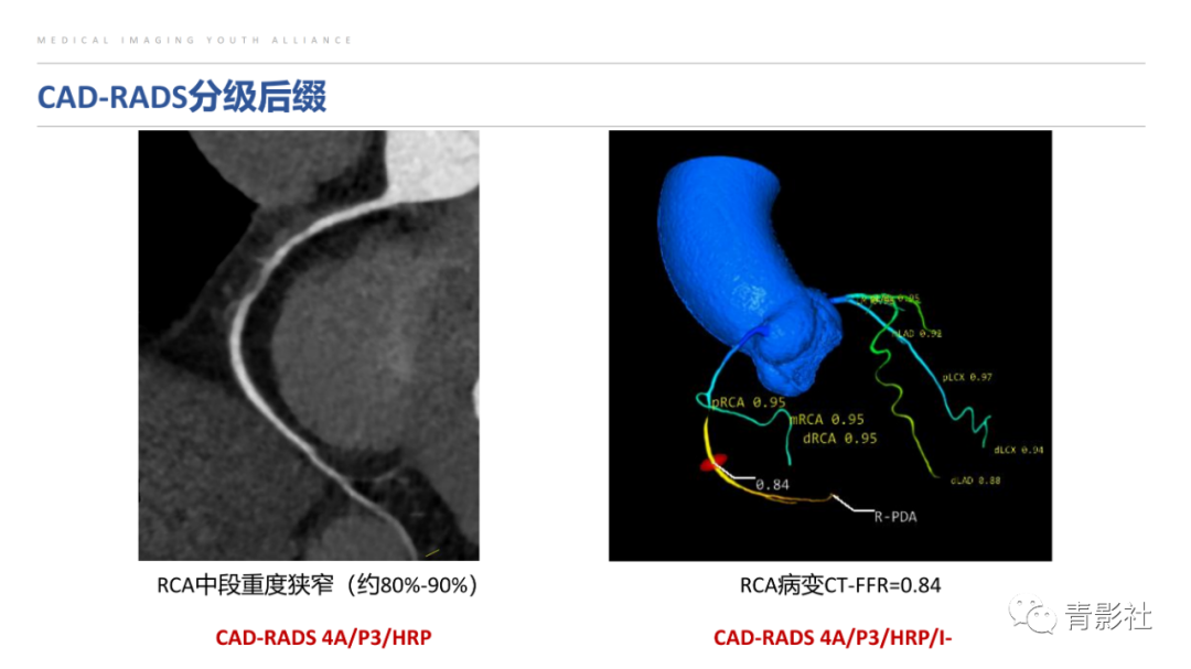 影像PPT - 【PPT】CAD-RADS 2.0报告分级解读-3