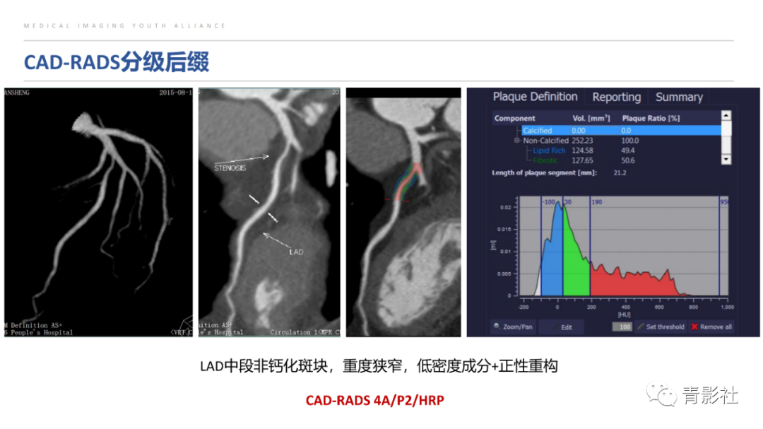 影像PPT - 【PPT】CAD-RADS 2.0报告分级解读-1