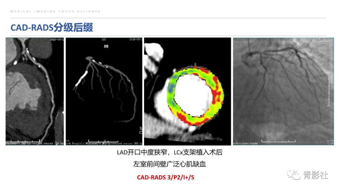 影像PPT - 【PPT】CAD-RADS 2.0报告分级解读-4