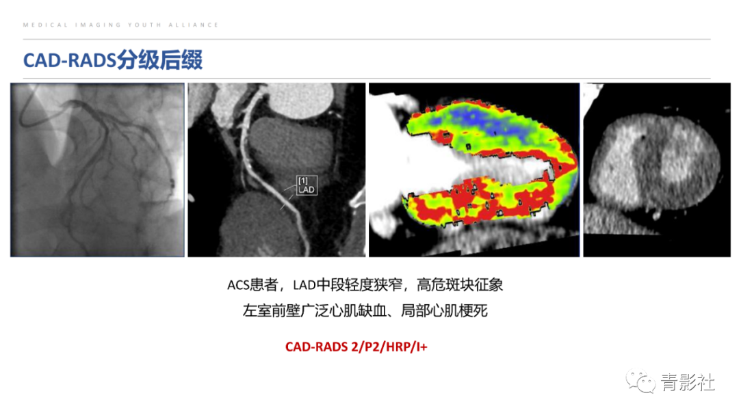 影像PPT - 【PPT】CAD-RADS 2.0报告分级解读-6