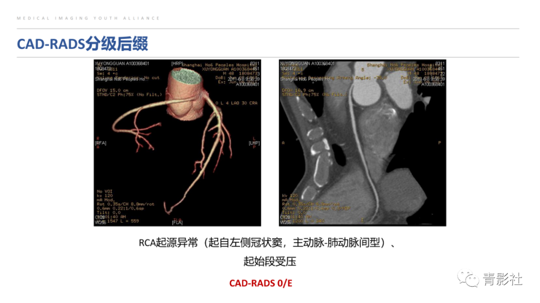 影像PPT - 【PPT】CAD-RADS 2.0报告分级解读-8