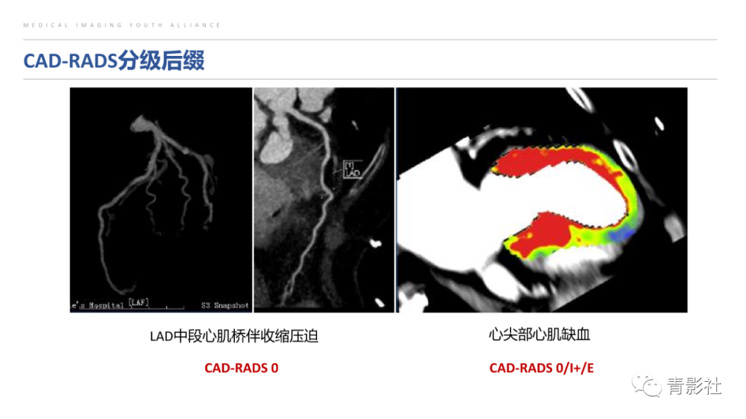 影像PPT - 【PPT】CAD-RADS 2.0报告分级解读-9