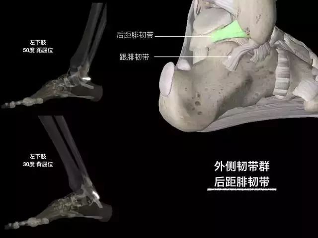 影像PPT - 踝关节韧带大体解剖及断层解剖高清图解-14 影像PPT - 踝关节韧带大体解剖及断层解剖高清图解-14
