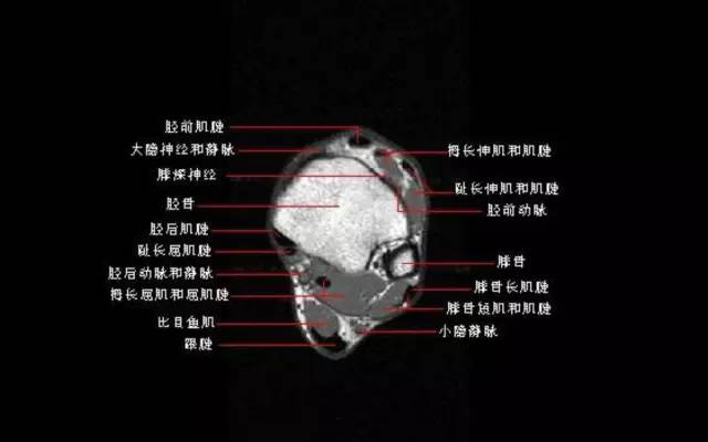 影像PPT - 踝关节韧带大体解剖及断层解剖高清图解-21 影像PPT - 踝关节韧带大体解剖及断层解剖高清图解-21
