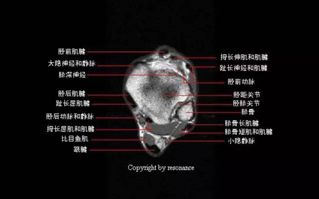 影像PPT - 踝关节韧带大体解剖及断层解剖高清图解-22 影像PPT - 踝关节韧带大体解剖及断层解剖高清图解-22