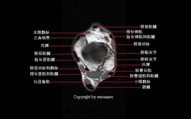 影像PPT - 踝关节韧带大体解剖及断层解剖高清图解-23 影像PPT - 踝关节韧带大体解剖及断层解剖高清图解-23