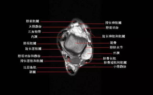 影像PPT - 踝关节韧带大体解剖及断层解剖高清图解-24 影像PPT - 踝关节韧带大体解剖及断层解剖高清图解-24