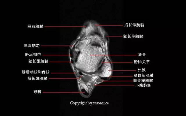 影像PPT - 踝关节韧带大体解剖及断层解剖高清图解-25 影像PPT - 踝关节韧带大体解剖及断层解剖高清图解-25