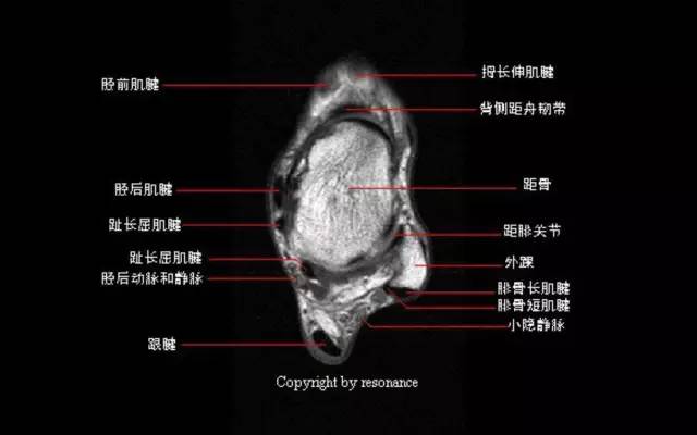 影像PPT - 踝关节韧带大体解剖及断层解剖高清图解-27 影像PPT - 踝关节韧带大体解剖及断层解剖高清图解-27