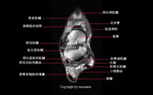 影像PPT - 踝关节韧带大体解剖及断层解剖高清图解-28 影像PPT - 踝关节韧带大体解剖及断层解剖高清图解-28