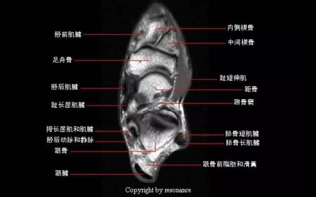 影像PPT - 踝关节韧带大体解剖及断层解剖高清图解-29 影像PPT - 踝关节韧带大体解剖及断层解剖高清图解-29
