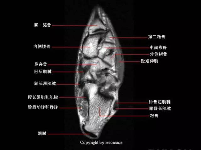 影像PPT - 踝关节韧带大体解剖及断层解剖高清图解-31 影像PPT - 踝关节韧带大体解剖及断层解剖高清图解-31