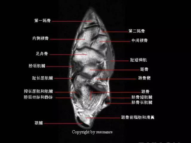 影像PPT - 踝关节韧带大体解剖及断层解剖高清图解-30 影像PPT - 踝关节韧带大体解剖及断层解剖高清图解-30
