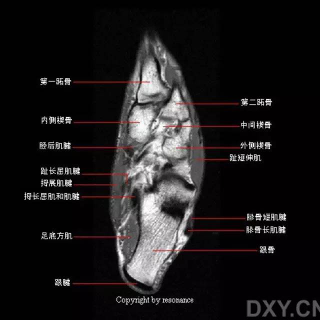 影像PPT - 踝关节韧带大体解剖及断层解剖高清图解-32 影像PPT - 踝关节韧带大体解剖及断层解剖高清图解-32