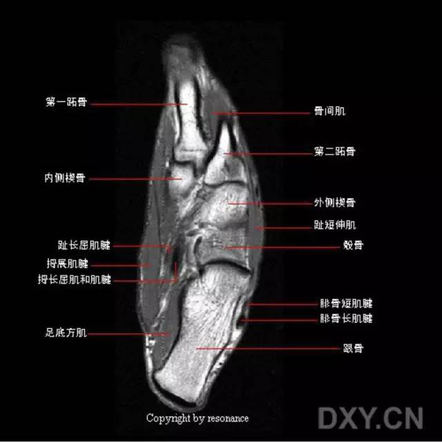 影像PPT - 踝关节韧带大体解剖及断层解剖高清图解-33 影像PPT - 踝关节韧带大体解剖及断层解剖高清图解-33